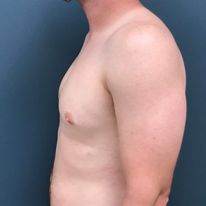 Gynecomastia Before & After Patient #1108