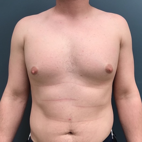 Gynecomastia Before & After Patient #1108