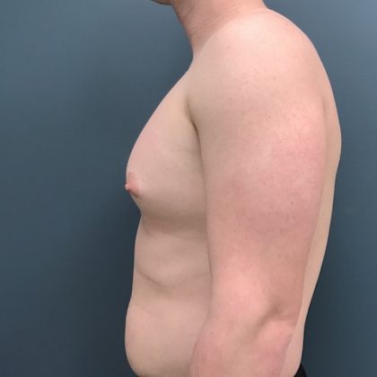 Gynecomastia Before & After Patient #1108