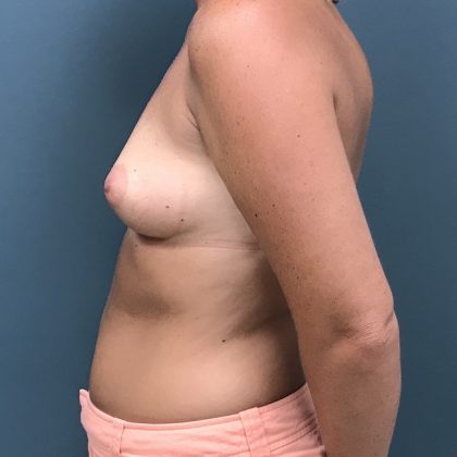 Breast Augmentation Before & After Patient #1163