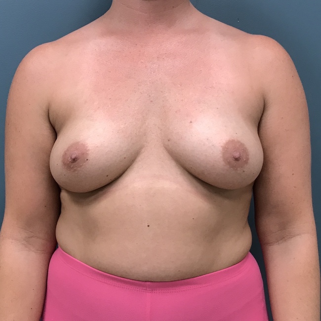 Breast Augmentation Before & After Patient #1174