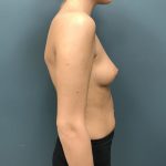 Breast Augmentation Before & After Patient #1227