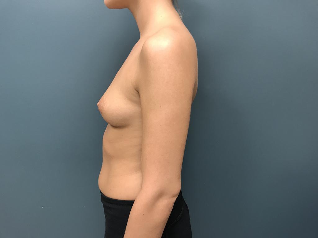 Breast Augmentation Before & After Patient #1227