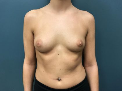 Breast Augmentation Before & After Patient #1227