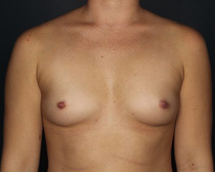 Breast Augmentation Before & After Patient #1212