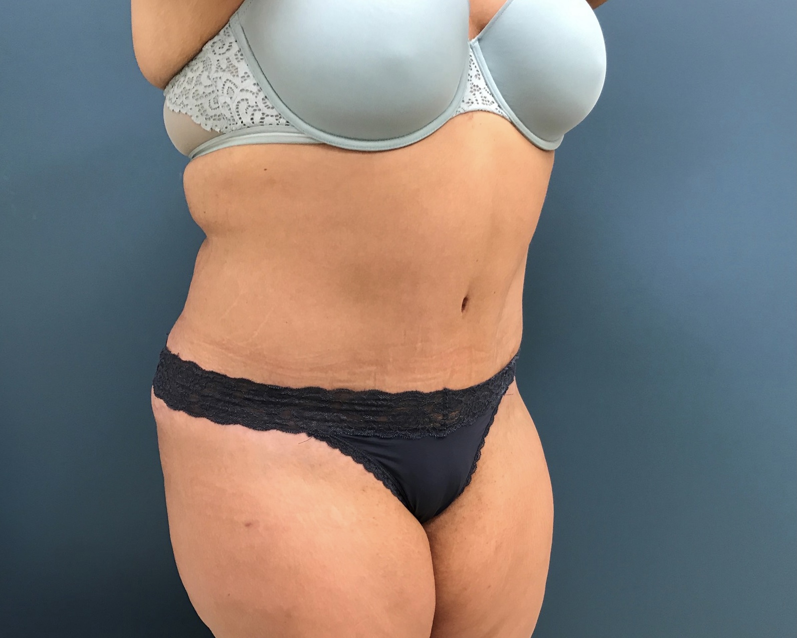Tummy Tuck Before & After Patient #1269