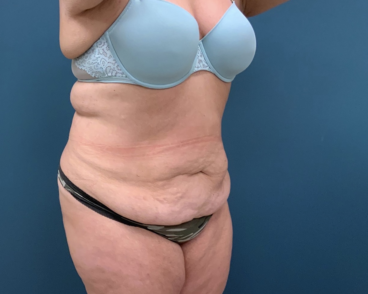 Tummy Tuck Before & After Patient #1269