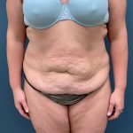 Tummy Tuck Before & After Patient #1269