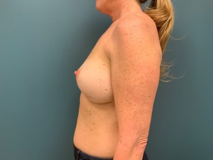 Breast Revision Before & After Patient #1276