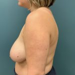 Breast Reduction Before & After Patient #1258