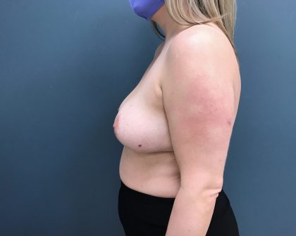 Breast Reduction Before & After Patient #1258