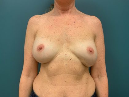 Breast Revision Before & After Patient #1276