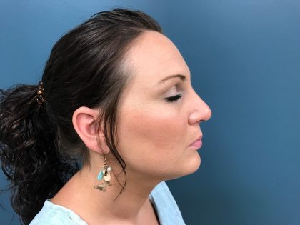 Rhinoplasty Before & After Patient #1285