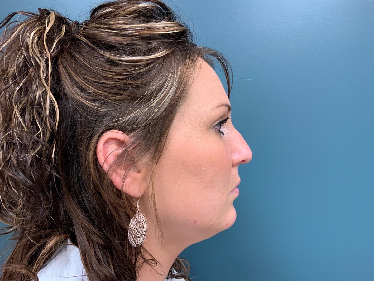 Rhinoplasty Before & After Patient #1285