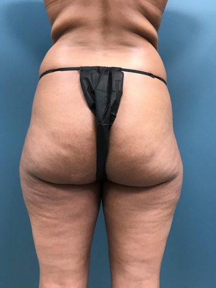 Patient #1242 Brazilian Butt Lift Before and After Photos