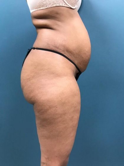 Brazilian Butt Lift Before & After Gallery: Patient 21
