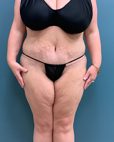 Patient #2278 Lower Body Lift Before and After Photos Lexington