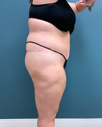 Patient #2278 Lower Body Lift Before and After Photos Lexington