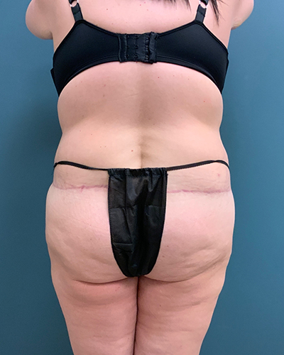 Body Lift Before & After Gallery: Patient 6