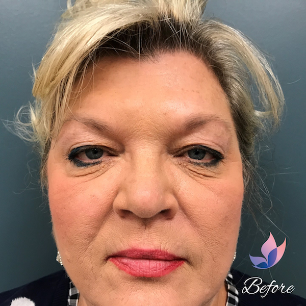 Blepharoplasty Before & After Patient #1391