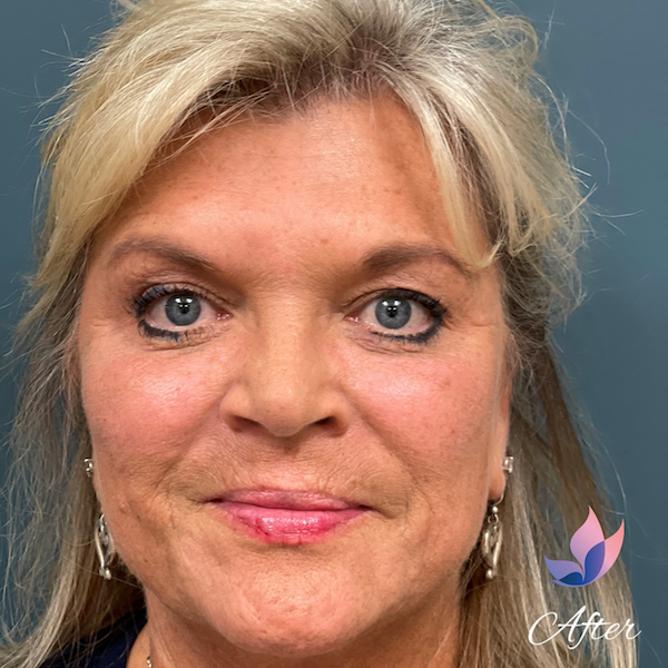 Blepharoplasty Before & After Patient #1391