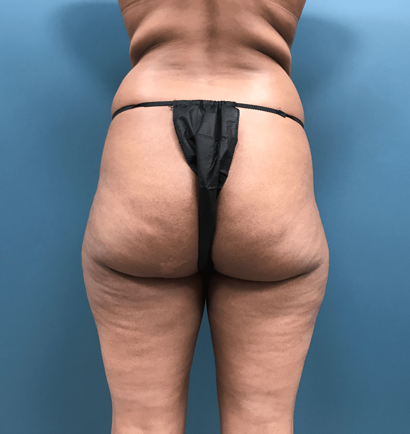 Brazilian Butt Lift Before & After Patient #1406