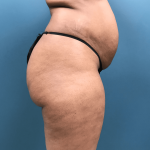 Brazilian Butt Lift Before & After Patient #1406