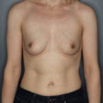 Breast Reconstruction Before & After Patient #1401