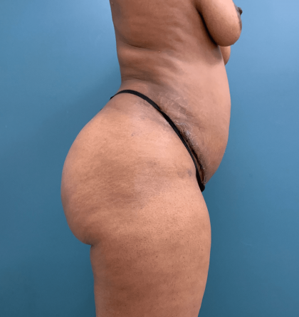 Brazilian Butt Lift Before & After Patient #1406