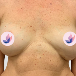 Breast Revision Before & After Patient #1427