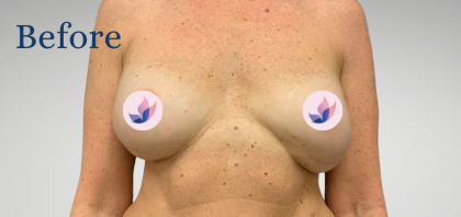 Breast Revision Before & After Patient #1427