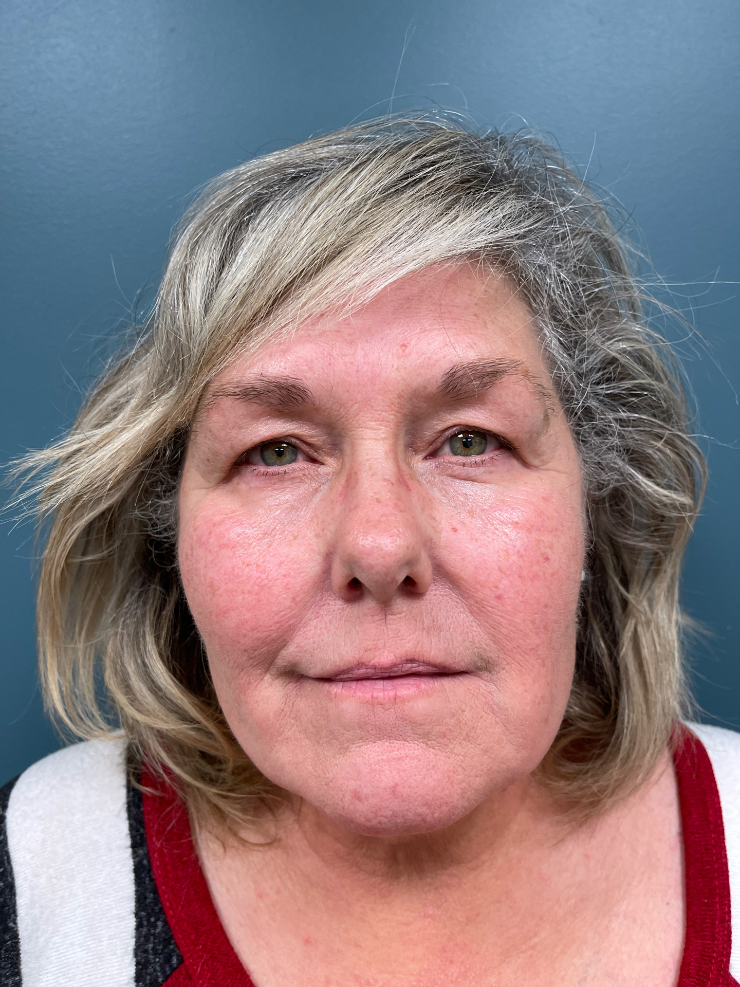 Blepharoplasty Before & After Patient #1481