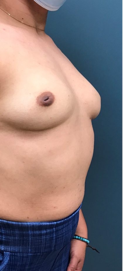 Breast Augmentation Before & After Patient #1527