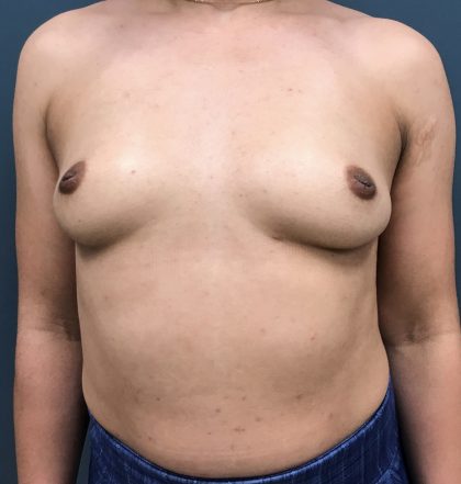 Breast Augmentation Before & After Patient #1527