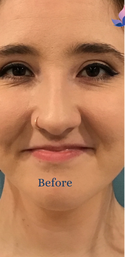 Fillers and Injectables Before & After Patient #1508