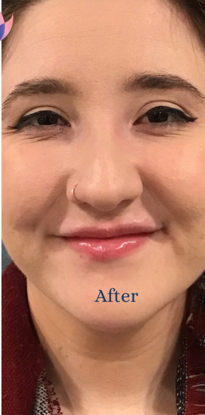 Fillers and Injectables Before & After Patient #1508