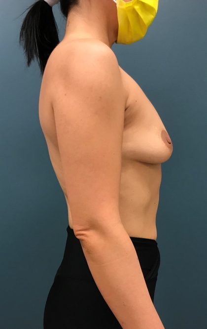 Breast Augmentation Before & After Patient #1528