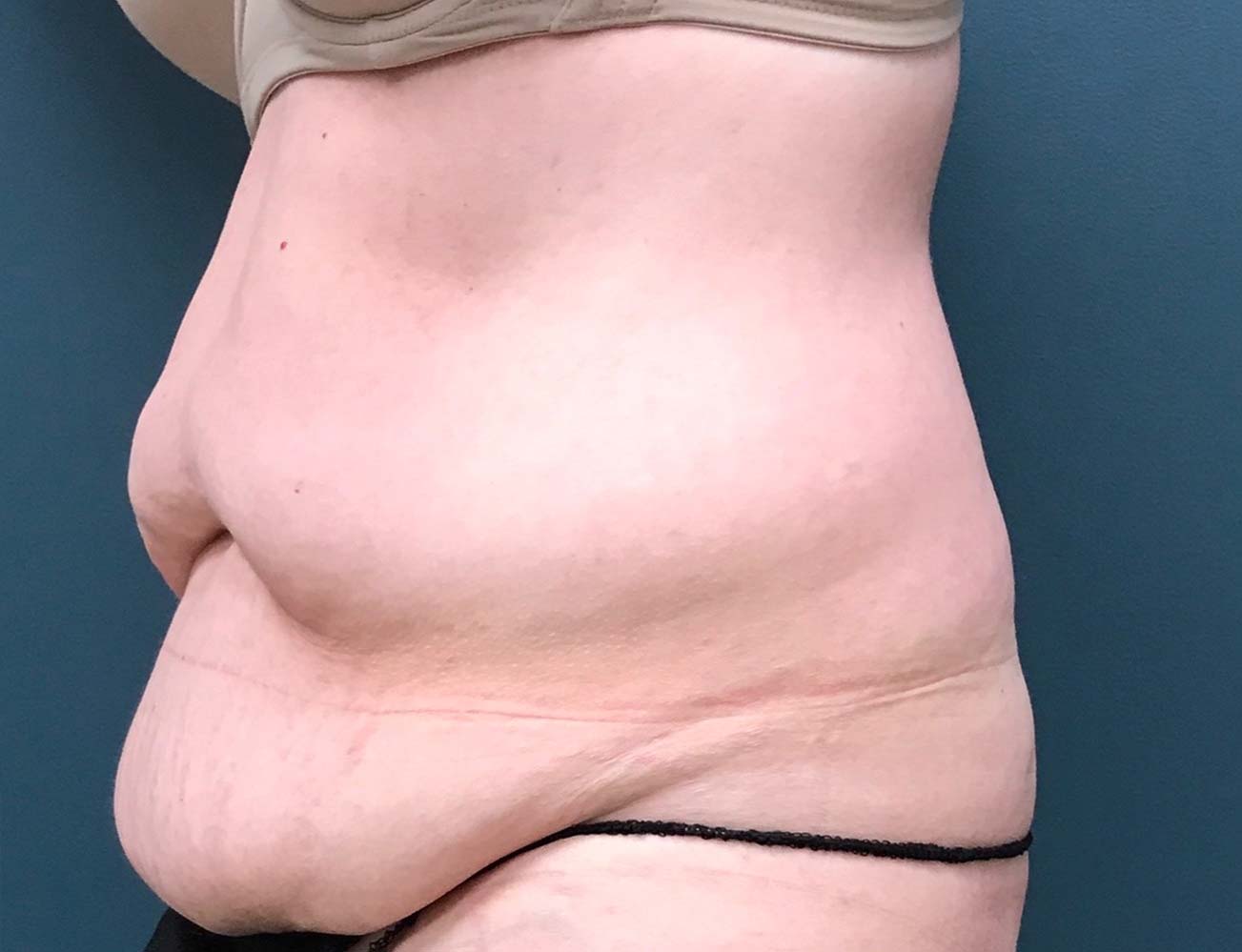 Tummy Tuck Before & After Patient #1569