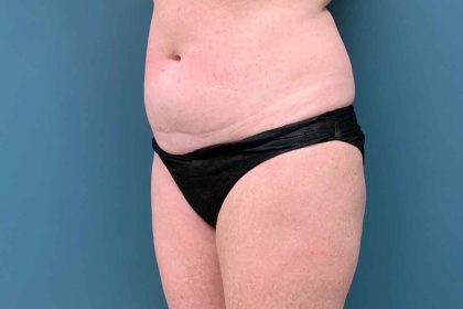 Tummy Tuck Before & After Patient #1553