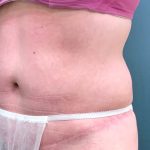 Tummy Tuck Before & After Patient #1569