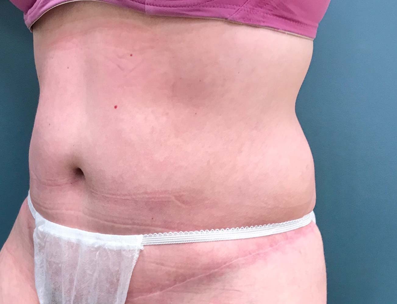 Tummy Tuck Before & After Patient #1569