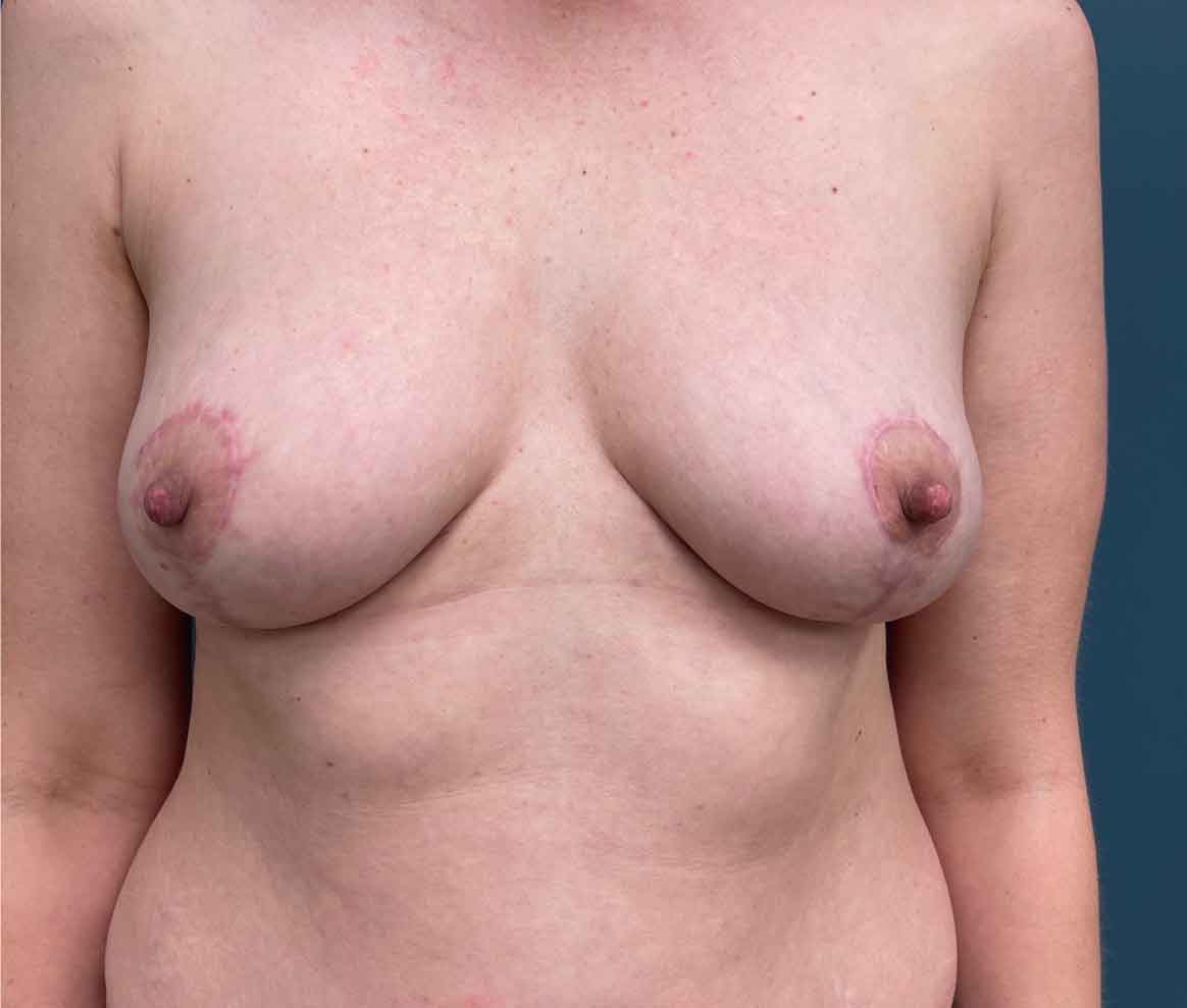 Breast Lift Before & After Patient #1582