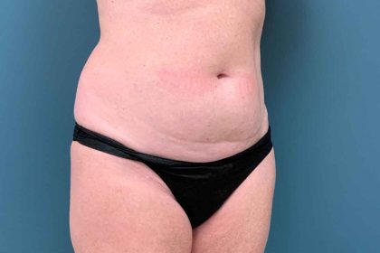 Tummy Tuck Before & After Patient #1553