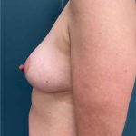 Breast Lift Before & After Patient #1582