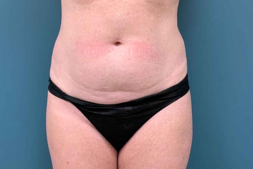 Tummy Tuck Before & After Patient #1553