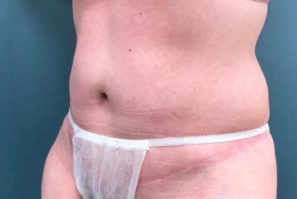 Tummy Tuck Before & After Patient #1569
