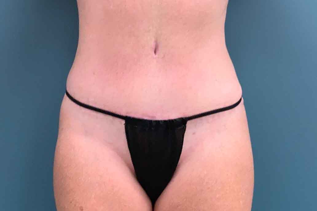 Tummy Tuck Before & After Patient #1553