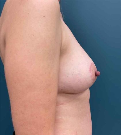 Breast Lift Before & After Patient #1582