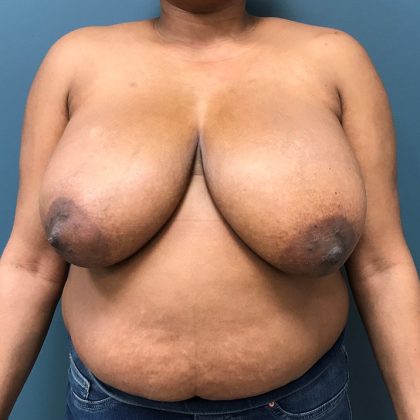 Breast Reduction Before & After Patient #1560