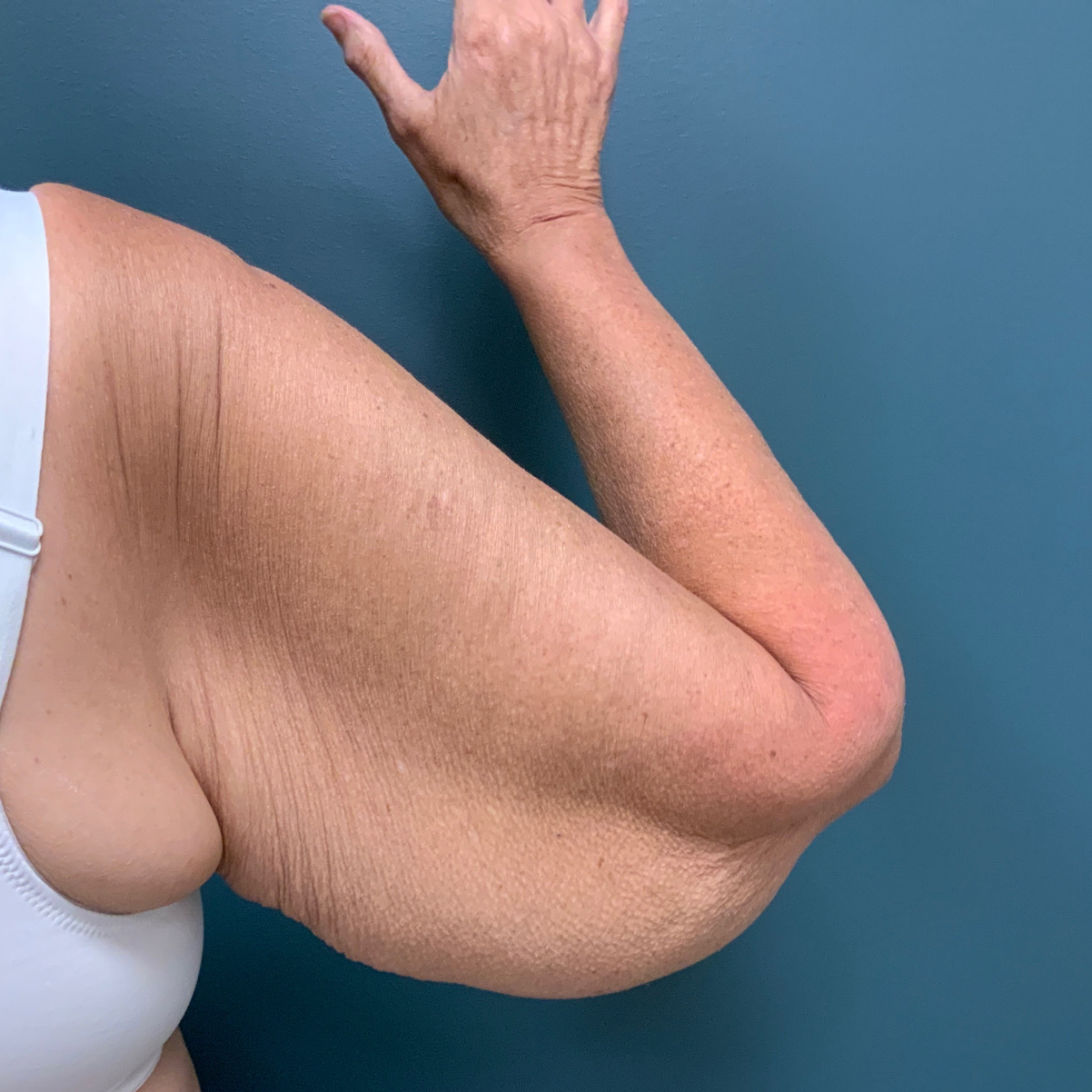 Arm Lift Before & After Patient #1540